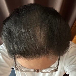 薄毛改善の検証実験開始より8ヶ月経過後　頭頂部状態　画像